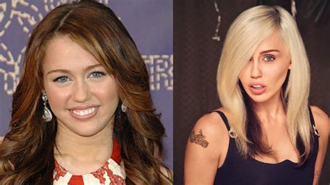 did miley cyrus get buccal fat removal